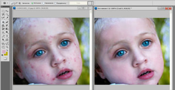 Как замазать прыщи при помощи Photoshop